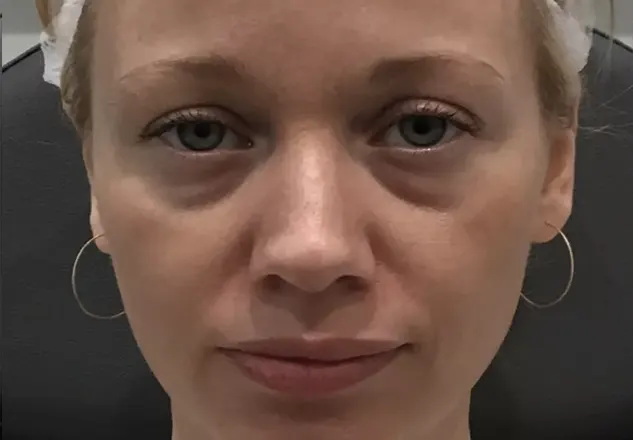 BEFORE & AFTER v22
